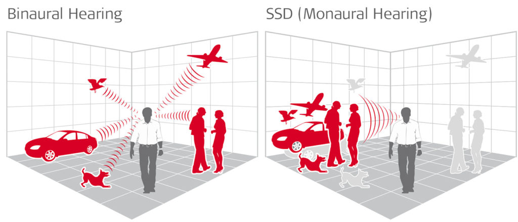 CI and hearing aid: binaural hearing illustration